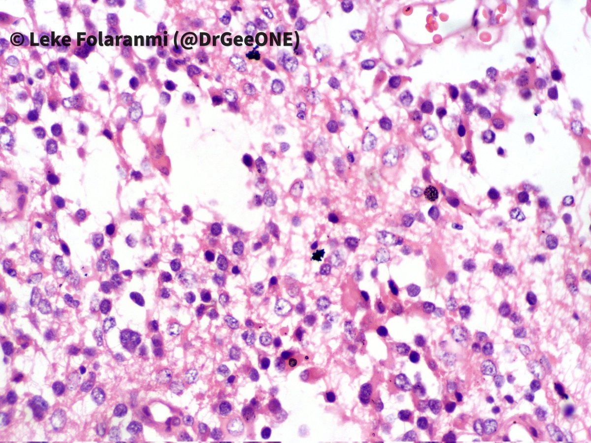 DrGeeONE's tweet image. Kindly share your thoughts on this case: Intraventricular mass in a 38 year old Male. 1/2
@CraigHorbinski
@neuropathmk @bitar_mireille
@mlage @FRodriguezNP #CNSPath #NeuroPath #PathTwitter #PathX