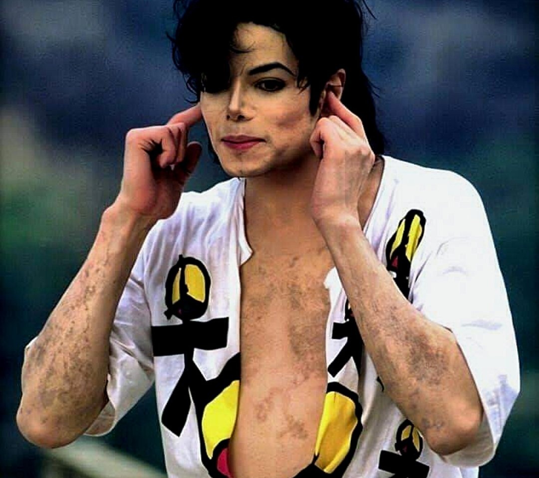 Vitiligo Michael Jackson Michael Jackson News Comic Vine