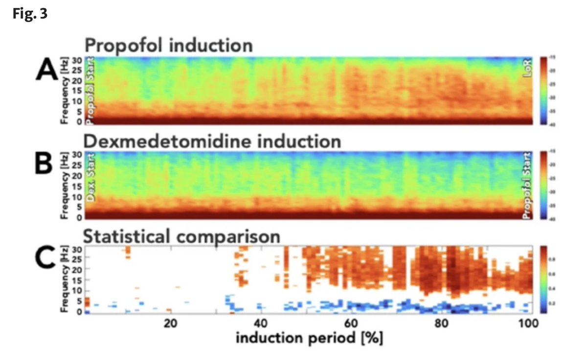 🔍 Anesthesia in Elderly: Comparing Prop-Remi vs. Dex-Prop-Remi in pts >69 yrs by Mehler, @alohias, @DrPSepuV, @francisco_alobo from @TU_Muenchen 🇩🇪🇨🇱🇦🇪 Both regimens prevented burst suppression on EEG, with no post-op neurocognitive deficits observed. link.springer.com/article/10.100…