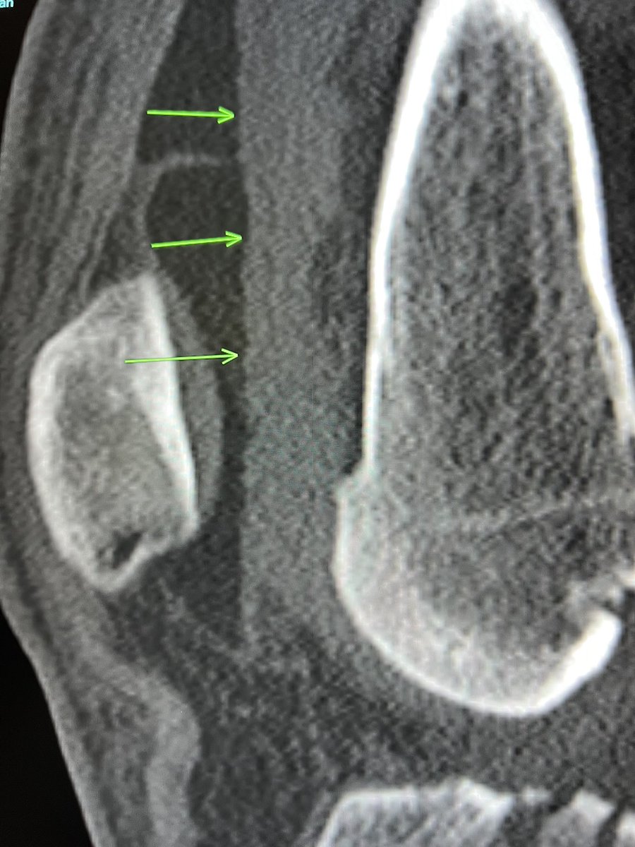 The lateral view of knee radiographs in acute trauma is always “cross-table lateral.” You will miss lipohemarthrosis on a regular lateral view (example here). Fortunately fracture was very obvious in this case. Amend your radiography trauma protocols if you are not doing…