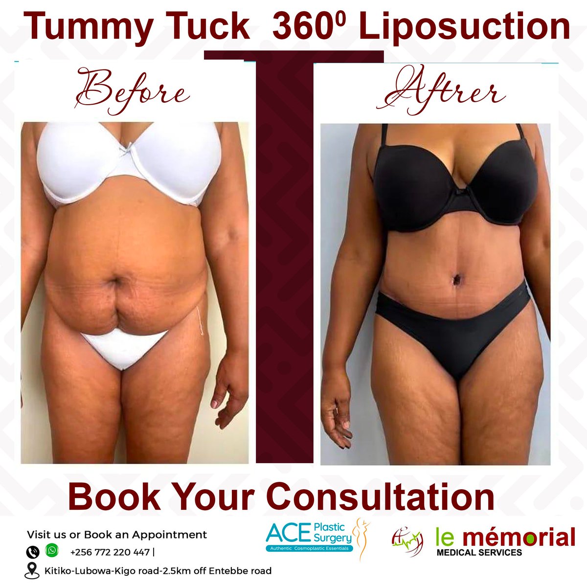 Get a smoother tummy with our Tummy Tuck 360° Liposuction!
We  now offer this amazing procedure to help you feel more confident. 

 +256 772 220 447 to schedule your appointment now!us today.
Located at  Kitiko-Lubowa, Kigo Road, 2.5km off Entebbe Road.
#TummyTuck #Liposuction