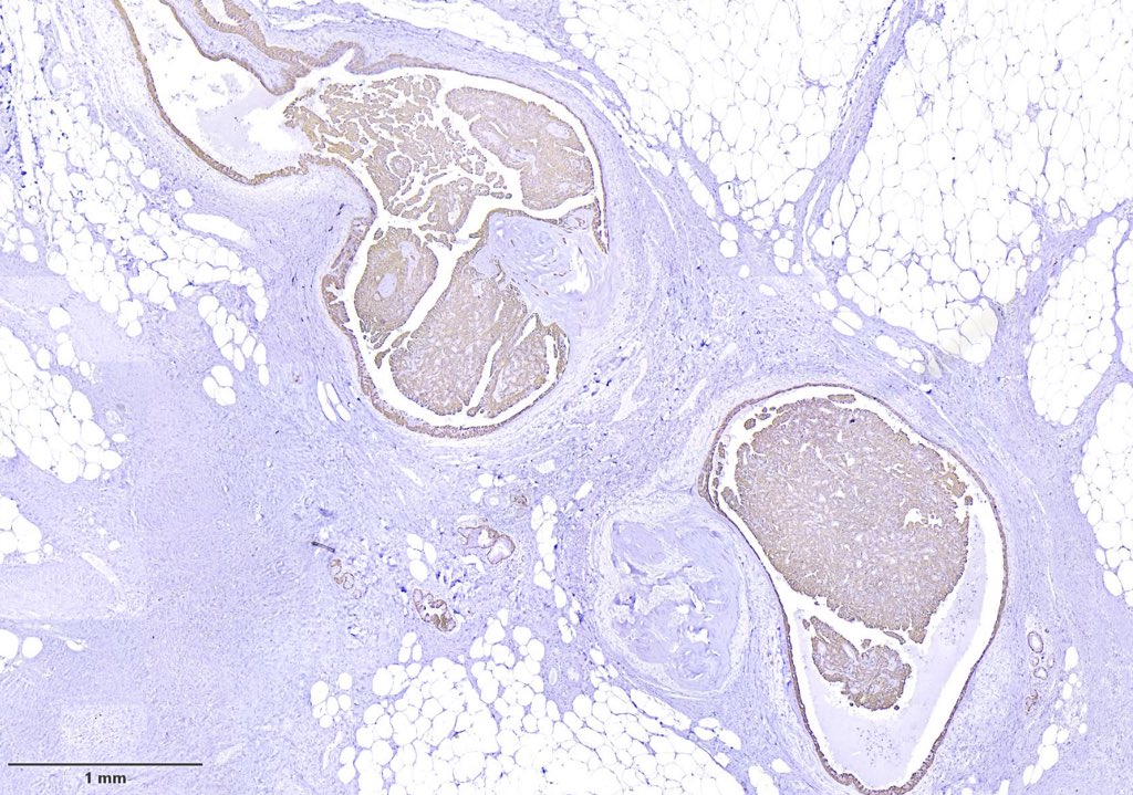 ArdalanFarid's tweet photo. @Sally_Touri Thanks for your comment. I will add some #immunostains for CK5/6 and P63 to help you fine-tune your diagnosis. https://t.co/uupi6v5j2H