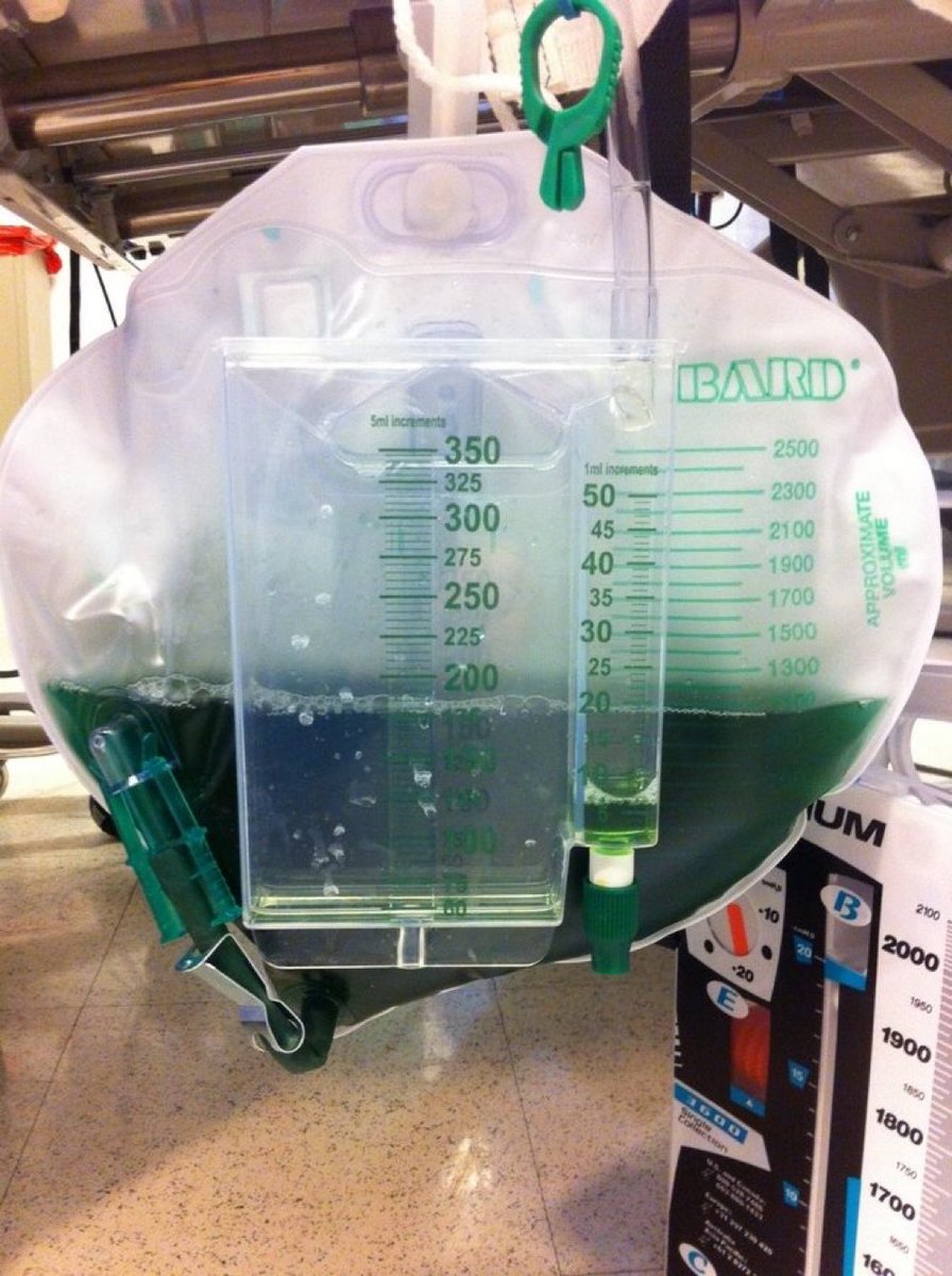 In true #MedEd x #StPatricksDay spirit, what is the cause of this urine discolouration?