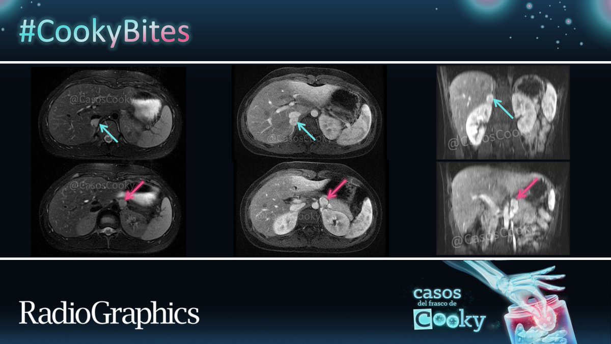 Antecedente de síndrome de Von Hippel-Lindau. ¿Cuales el diagnóstico? Publicaremos la respuesta en 24 horas. Comparte los casos usando #CookyBites #CasosCooky #109. Repostearemos los mejores casos. #RGphx @cookyscan1 @RadioGraphics