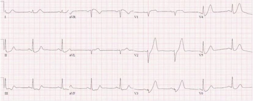 70 year old with chest pain. What do you think? @ECGcases @EMCases #ECG #EKG #FOAMed #MedEd #CardioEd #CardioTwitter #medicalschool #MedstudentTwitter #paramedic #emergencymedicine