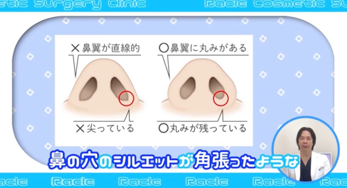 lala_ruuu's tweet photo. 人中短縮、小鼻縮小で小鼻の巻き込みを切られると100％ここ尖ってると思う
そもそも顔は曲線、立体で出来ているからそこに直線が生まれると必ず不自然になる
この部分が尖って角が出来ると、鼻孔底も下がって見えるし直線が発生して鼻が崩壊する⚠️ https://t.co/jHQNdllLpa
