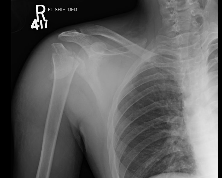 This week, Dr Kiel shares an unusual case of bilateral proximal humerus fractures! Read More: sportsmedreview.com/blog/case-repo… #sportsmed #sportsmedicine #ebm #medicine #sports #foamSM #MedEd #FOAMed #ortho #medtwitter #OrthoTwitter #physicaltherapy #athletictraining