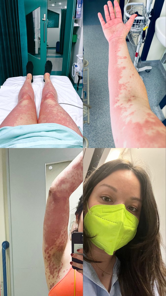 I’m late to #LongCovidAwarenesDay here but a year ago I was hospitalised with the rare Stevens-Johnson Syndrome after Covid (1st and only) activated EBV then destroyed my immune system. It’s still very broken and I’m propped “up” on a lot of immune suppressants. 1/3