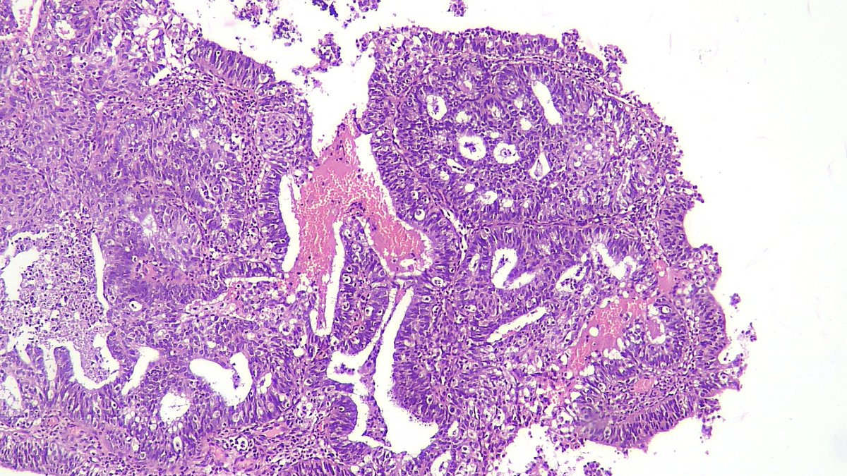 Dramanyhassany1's tweet photo. #gynpath A combo of endometrioid carcinoma and endometrial Schistosomiasis. https://t.co/hfDenz0i2e