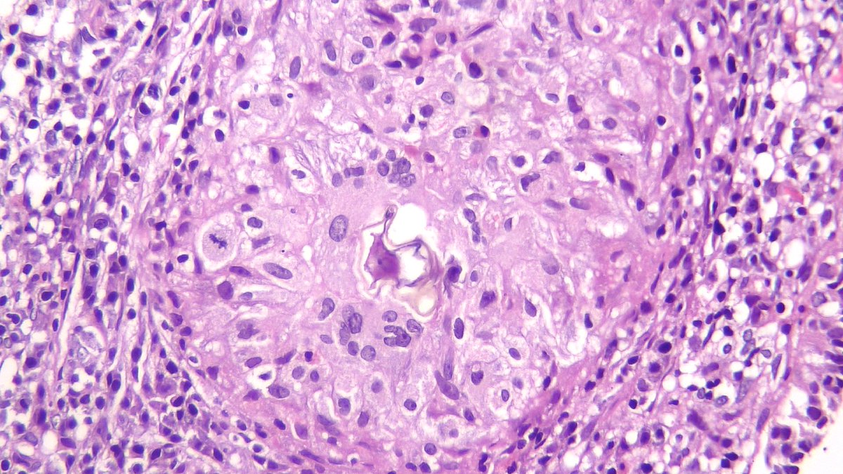 Dramanyhassany1's tweet photo. #gynpath A combo of endometrioid carcinoma and endometrial Schistosomiasis. https://t.co/hfDenz0i2e