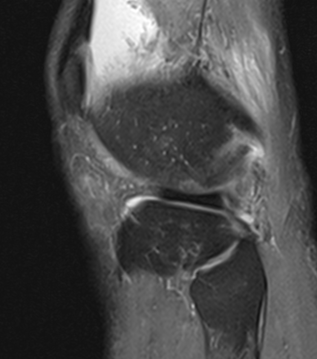 PLC Injury Tear of LCL and Popliteal tendon. Ill defined arcuate lig. Partial Thickness tear ACL.
