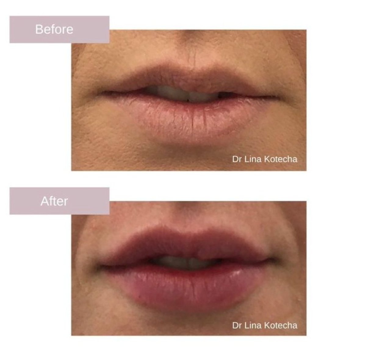 This lovely lady asked for a little bit more volume but not a trout pout. This look was achieved using the highest quality dermal filler RHA3. 😍 #fbllips #lipfillersleicester