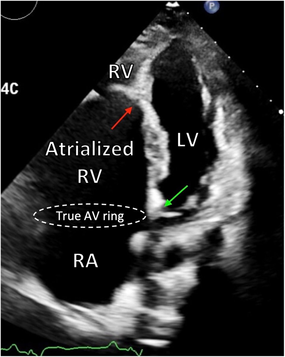 Ebstein anomaly (EA), a congenital heart disease with an anatomic malformation of the tricuspid valve (TV) and right ventricular (RV) myopathy, can present in both children and adults. bit.ly/3T7DwxO #CASESpecialIssue #10DaysofCASE #ACHD