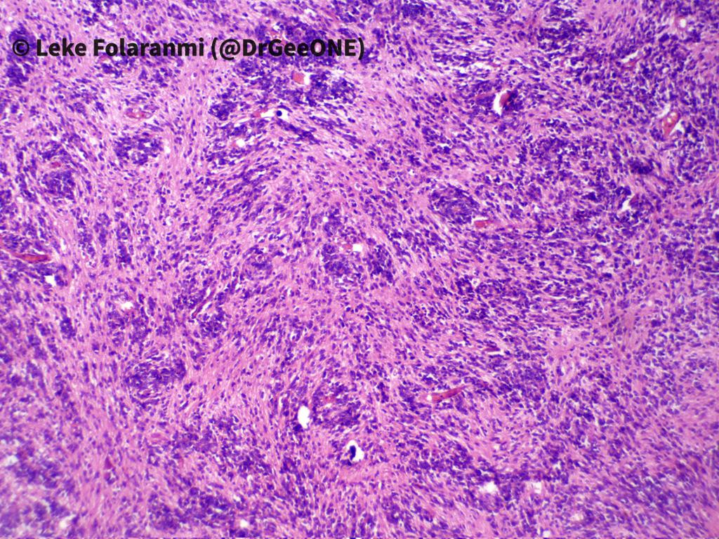 DrGeeONE's tweet image. 2/2
@CraigHorbinski
@neuropathmk @bitar_mireille
@mlage @FRodriguezNP #CNSPath #NeuroPath #PathTwitter #PathX