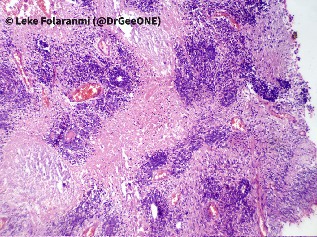 DrGeeONE's tweet image. 2/2
@CraigHorbinski
@neuropathmk @bitar_mireille
@mlage @FRodriguezNP #CNSPath #NeuroPath #PathTwitter #PathX
