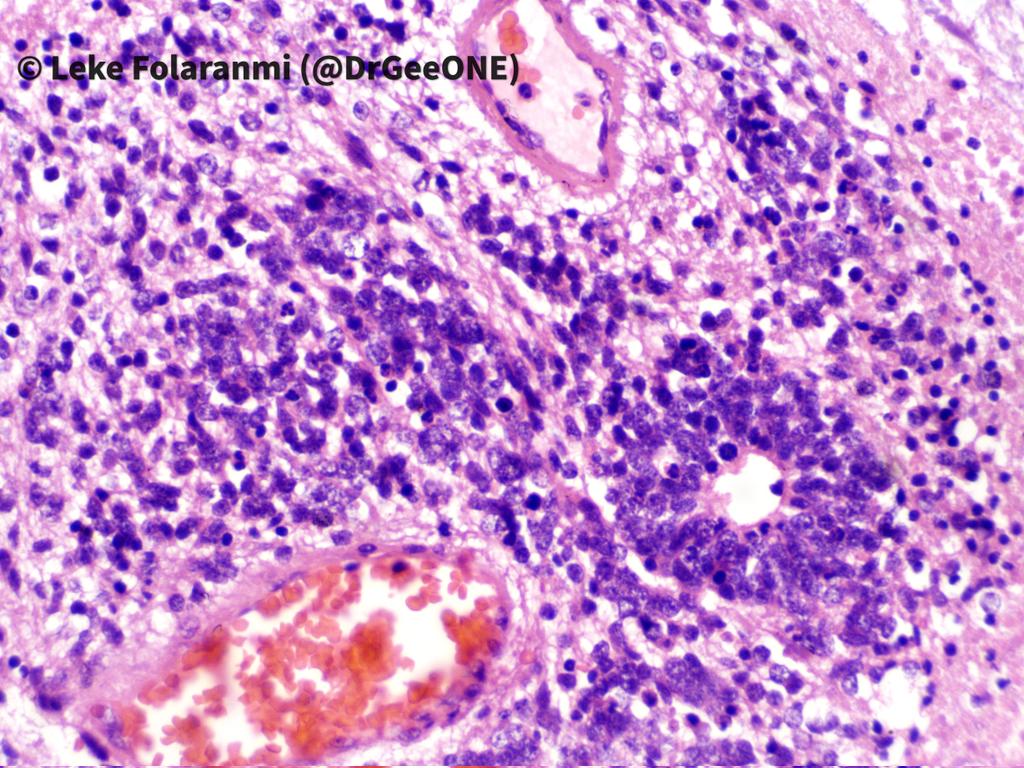 1/2 2YOM with recurring seizures. Imaging shows large brain parenchymal mass-The surgeons say it appears 'extra axial'...attached to the falx but not infiltrating the brain. This looks like embryonal tumour with abundant neuropil and rosettes (now ETMR) to me #CNSPath #Neuropath