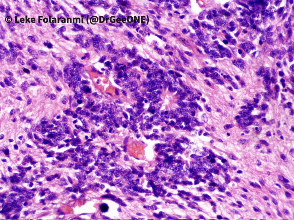 DrGeeONE's tweet image. 1/2 
2YOM with recurring seizures. Imaging shows large brain parenchymal mass-The surgeons say it appears "extra axial"...attached to the falx but not infiltrating the brain.
This looks like embryonal tumour with abundant neuropil and rosettes (now ETMR) to me #CNSPath #Neuropath