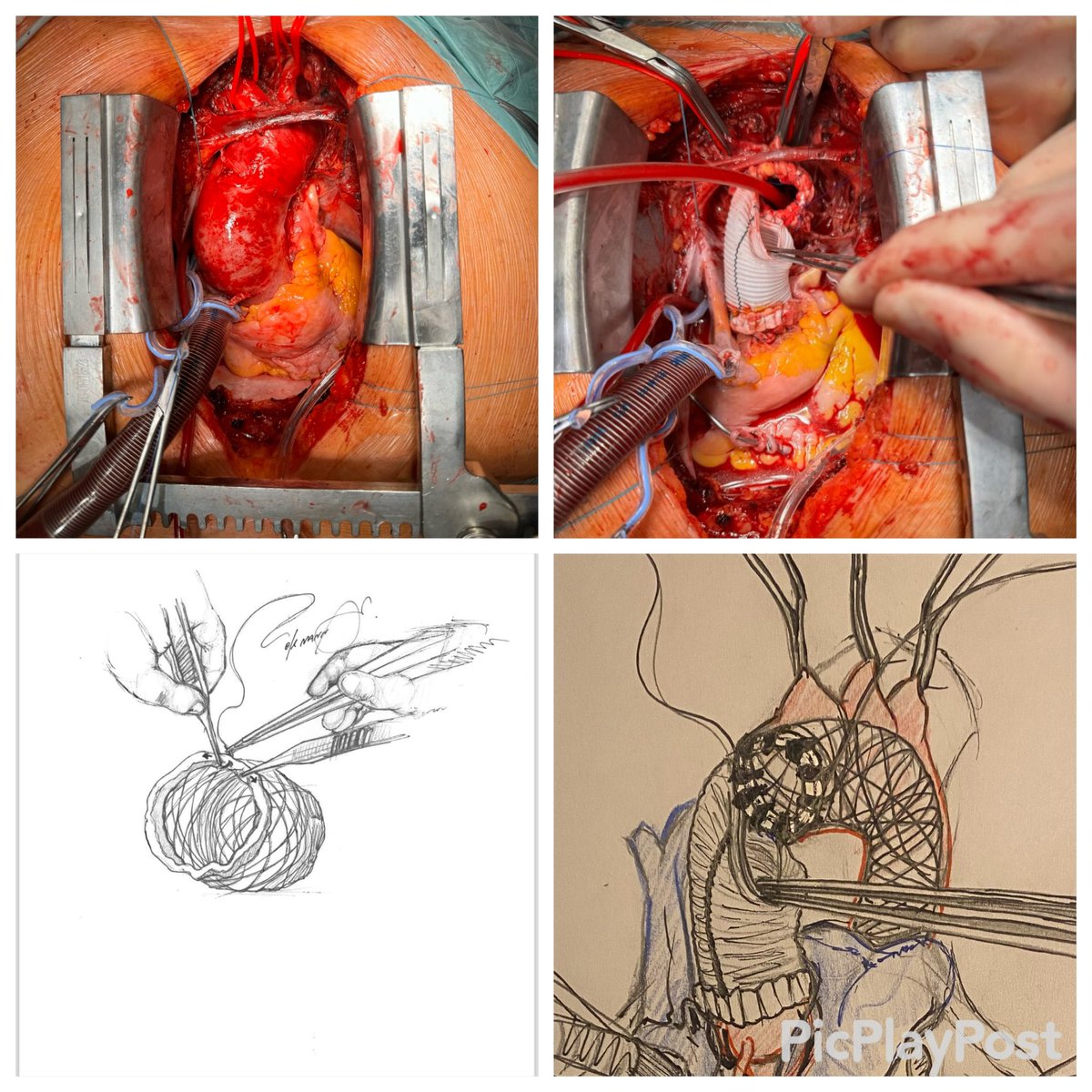 The  AMDS-Stent is a very good option in treating acute aortic type A dissection
Stretching the felt during performing the anastomosis might be one key of success avoiding aortic stenosis and collapsing . Many thanks to Davide de Manna for sharing the illustrations.