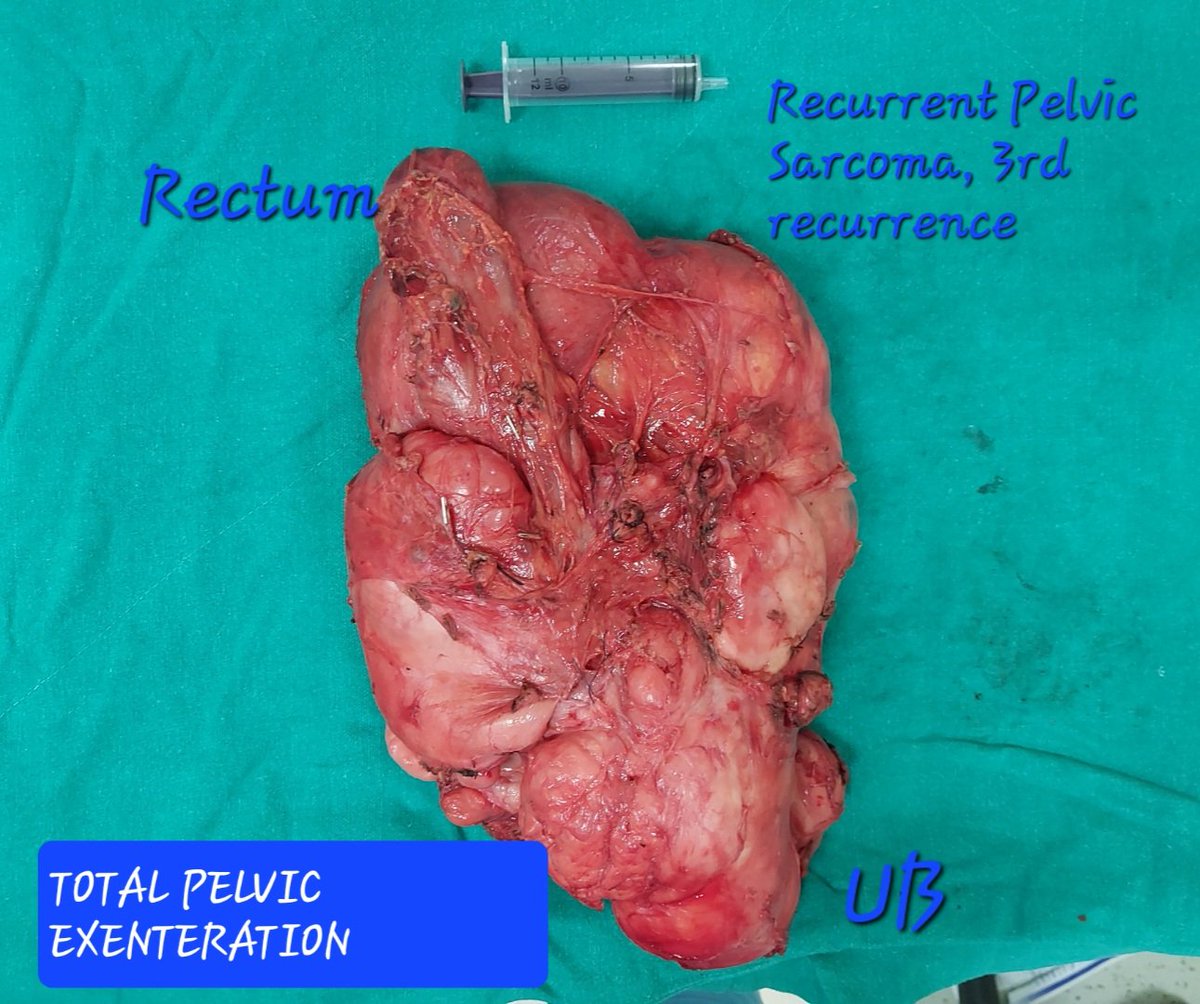 drsanjeev2003's tweet image. #GIOncology 
#highvolume #cuttingedge 
#pushingthelimits 
EXCITING 7 days, complex &amp;amp; challenging Sc
Total Pelvic #Exenteration,  #Whipple with Portal vein resection, 4 GB masses,  EHBTE, Liver resection,  #CYTOREDUCTION, #robotic  LAR, #Retroperitoneal sarcoma, RPLND  many more..