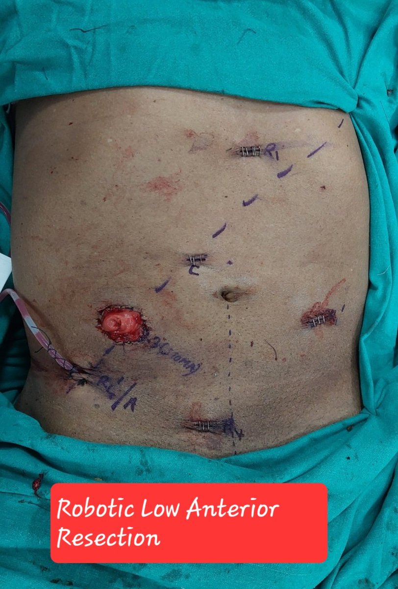 drsanjeev2003's tweet image. #GIOncology 
#highvolume #cuttingedge 
#pushingthelimits 
EXCITING 7 days, complex &amp;amp; challenging Sc
Total Pelvic #Exenteration,  #Whipple with Portal vein resection, 4 GB masses,  EHBTE, Liver resection,  #CYTOREDUCTION, #robotic  LAR, #Retroperitoneal sarcoma, RPLND  many more..