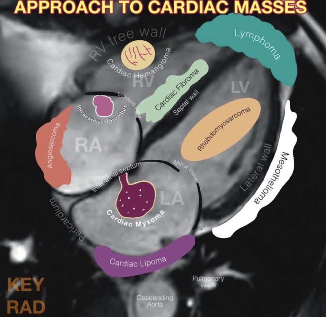 Cardiac masses by location 🫀 From #keyradiologist