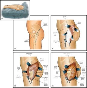 Gluteal Compartment Syndrome (GCS) after trauma is rare but serious. A case study highlights its risks, emphasising fast diagnosis and treatment. How can we improve diagnosis and treatment strategies?

ncbi.nlm.nih.gov/pmc/articles/P…

#SentinelpH #MedTech #medicalresearch