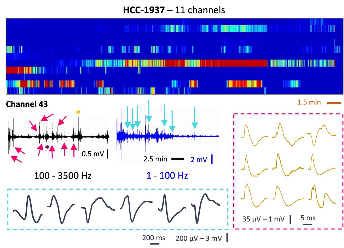 rosaliamoreddu's tweet photo. Here is a raster plot of… #cancer cells 🧫
This #preprint contains part of our preliminary data on the presence of extracellular spiking and bursting behavior in cancer cells resembling the one observed in excitable cells https://t.co/2dHABy5dpY https://t.co/cOk97uFI2L