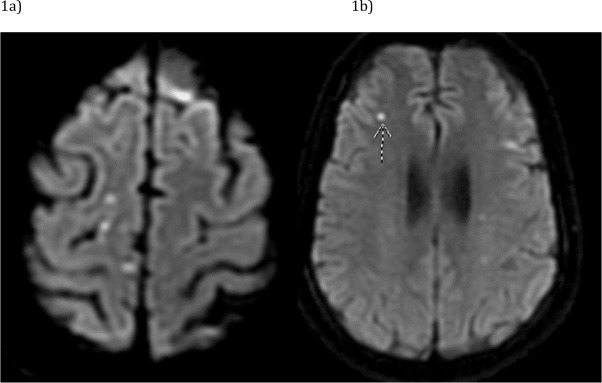 Learn more about this recently published article from Leukemia Research Reports Intravascular large B-cell lymphoma masquerading as stroke successfully treated with R-Hyper-CVAD Read now: spkl.io/60194Ih5S