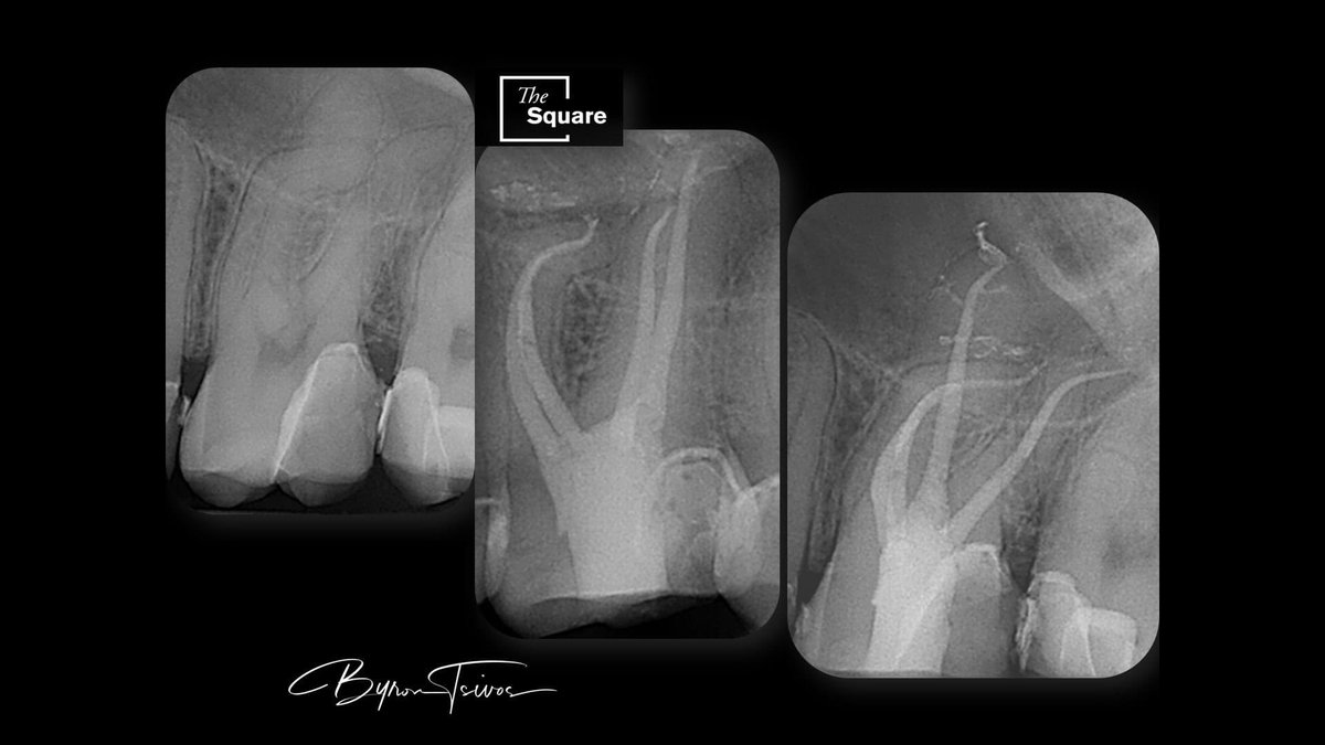 You love to hate and hate to love these cases. 26 molar with extreme curvatures managed with Hyflex EDM OGSF, irriflex  of course and CWC technique ZOE sealer and fast pack pro fast fill. Living on edge here