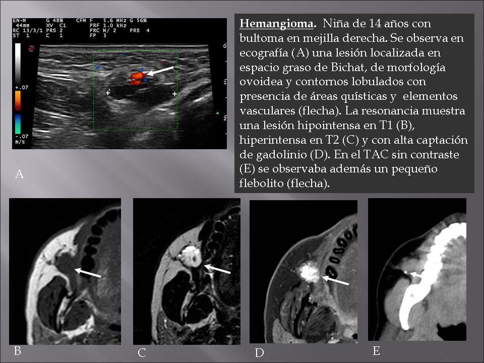 Nuevo caso de nuestra serie de tumores y pseudotumores de partes blandas: correlación ECO-RM. Malformación venosa AKA hemangioma de partes blandas👇🏻 #radres #mskrad @MskSerme