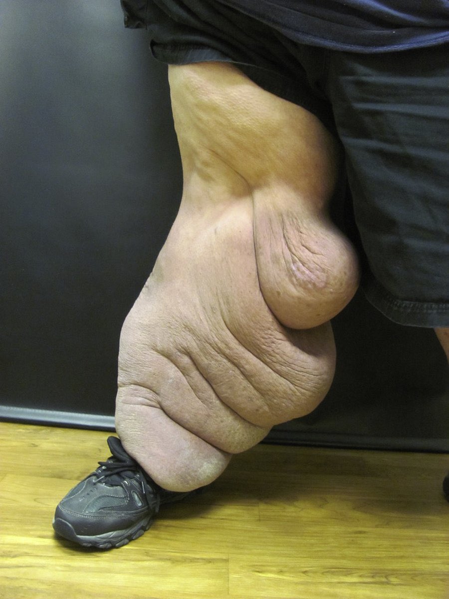 JVS - Venous and Lymphatic Disorders tweet media