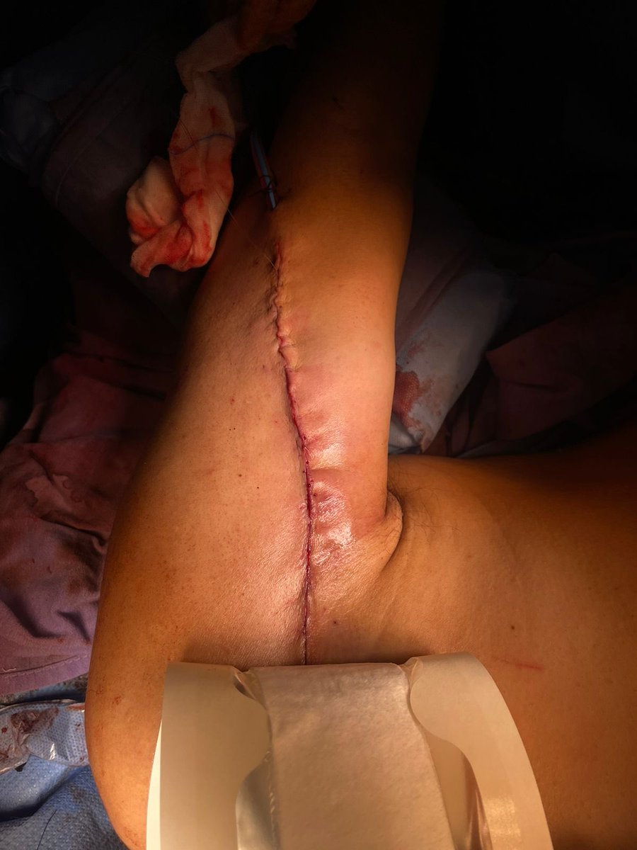 Lunes de reconstrucción post remoción de condrosarcoma. Trabajo realmente exigente, pero con en súper equipo, todo se puede! #anestesia #cancer #cirugiareconstructiva #CDMX #lunes #despierta #oncologos #turismomedico #viralpost