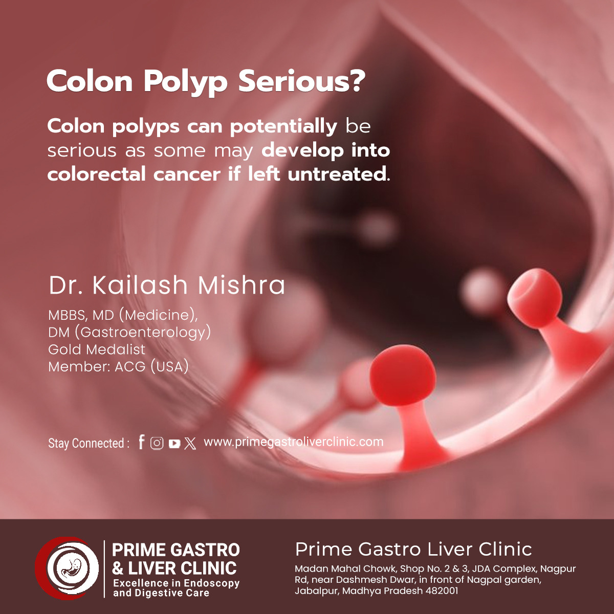 drkailashmishra's tweet image. #Colonpolyps are growths that can form in the lining of the #colon or #rectum. While many polyps are harmless, some types have the potential to become a serious #health concern.

Read More: lnkd.in/dsRj8WxB and contact on 9826014491
#gastroenterology #gastroenterologist