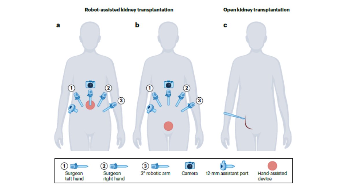 Fundació Puigvert Barcelona (@fpuigvert) on Twitter photo "Robot-Assisted #KidneyTransplantation is an alternative to the traditional open approach. Although patient selection remains crucial, latest technological advances are currently expanding the boundaries of #RAKT."
<a href="/BasileG_/">Giuseppe_Basile</a> in #PuigvertInScience
🔗pubmed.ncbi.nlm.nih.gov/38480898 "Robot-Assisted #KidneyTransplantation is an alternative to the traditional open approach. Although patient selection remains crucial, latest technological advances are currently expanding the boundaries of #RAKT."
<a href="/BasileG_/">Giuseppe_Basile</a> in #PuigvertInScience
🔗pubmed.ncbi.nlm.nih.gov/38480898
