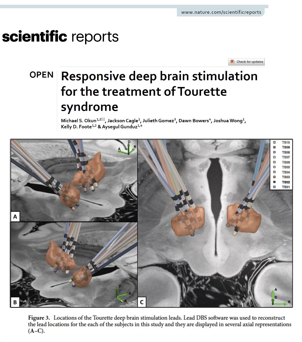 Results of a multi-year study on ‘responsive’ deep brain stimulation (DBS) for Tourette syndrome' sponsored by <a href="/NIH_NINDS/">NINDS</a> were published today in <a href="/Nature/">nature</a> <a href="/SciReports/">Scientific Reports</a>. Cool observations on human tic physiology and beyond.
Key Points:
- The use of ‘brain derived physiology’ was