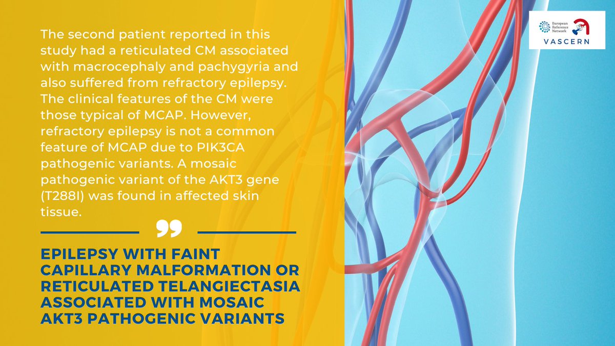 vascern's tweet photo. #ResearchHighlight: New study presents two young patients with a capillary malformation-like phenotype and #epilepsy associated with a mosaic pathogenic variant of the AKT3 gene.
Read about it here👉https://t.co/I4j7Ef5hvT
#raredisease #malformations #genetics #research #MedEd https://t.co/zzHeSaI6ja