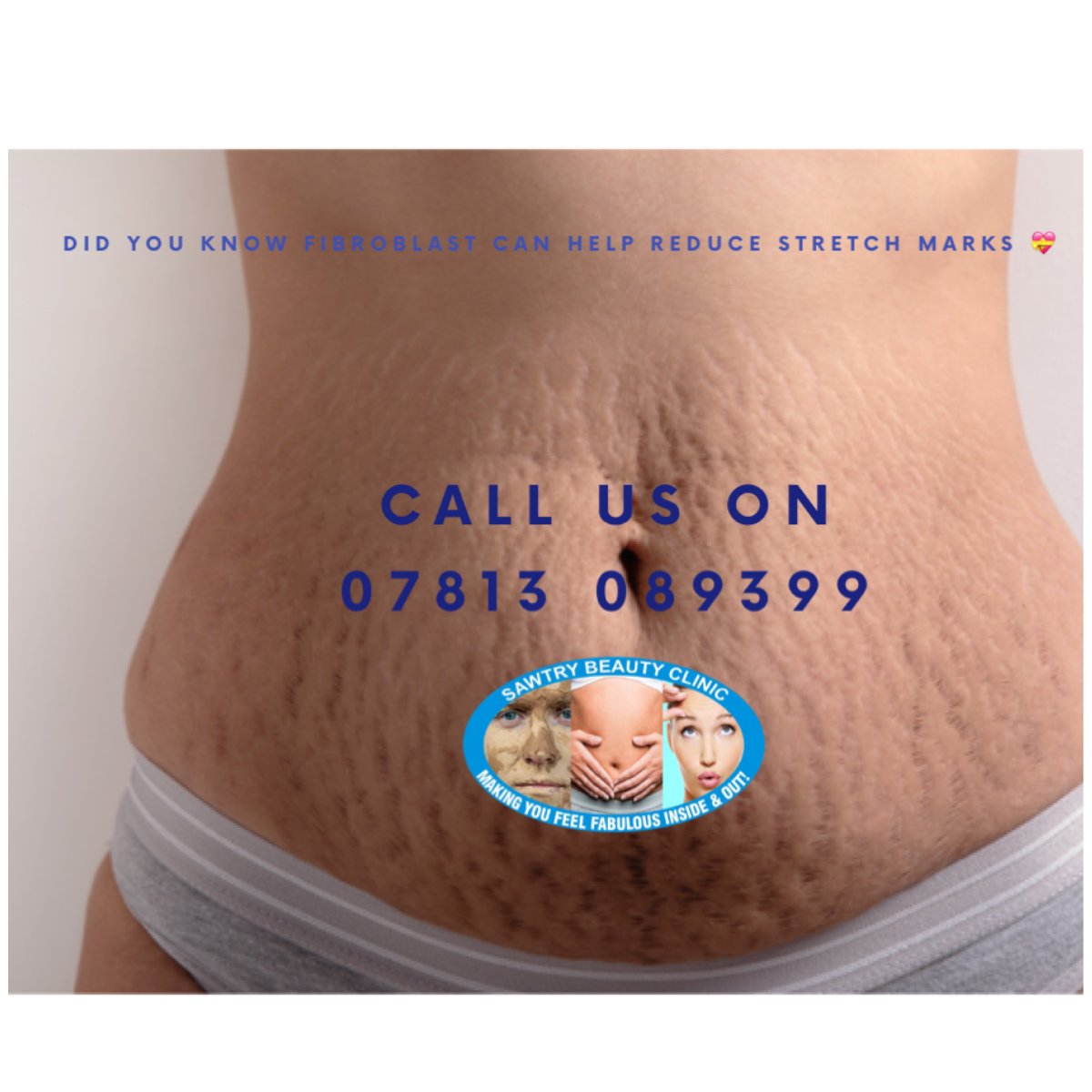 BeautySawty's tweet photo. Did you know that Fibroblast treatment can effectively reduce #StretchMarkReduction
Fibroblast treatment works by stimulating collagen production in the skin, leading to improved elasticity & texture.
#Fibroblast #SawtryBeautyClinic https://t.co/pMPVjaeYHS