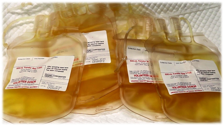 cardiomet_CE's tweet photo. 12c) If #4FPCC is unavailable you may give 15-30mL/kg #FFP
FFP contains factors II, VII, IX, X + fibrinogen & platelets. 1 unit = 250mL https://t.co/Ux8ZcNtw4d