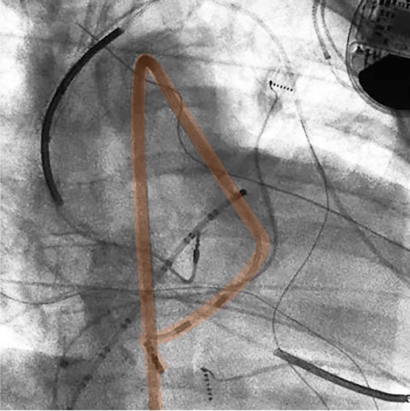 #RoboticEP enabling treatment for complex #CHD patients❤

Redo mustard patient treated robotically using a retrograde approach without needing to puncture the baffle. We are particularly proud to help provide options for underserved patients.

@Peteweissmd @su_wilber