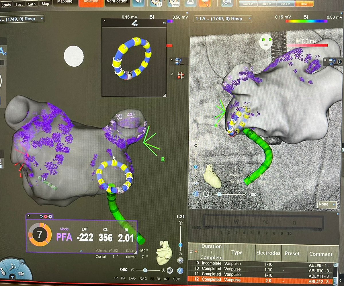 Tom De Potter (@tomdepotter) on Twitter photo Full circle for circular PFA! Exactly 1300 days ago we did the first ablation ever  with #varipulse and today  ⭕️ PFA is back with the world’s first non-study case. Smooth case - quite a bit faster than the regulatory process 😉 Full circle for circular PFA! Exactly 1300 days ago we did the first ablation ever  with #varipulse and today  ⭕️ PFA is back with the world’s first non-study case. Smooth case - quite a bit faster than the regulatory process 😉
