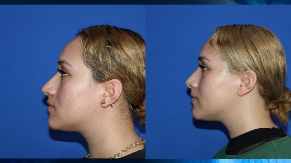 jesusgodinez's tweet photo. Rinoplastia, Resultados naturales Gracias por su confianza #doctorjesusgodinez, #cirugiafacialgodinez, #rinoplastiasegura, #rinoplastia, #resultadospermanentes, #elresultadoesindividual, https://t.co/bRXNion9Ub