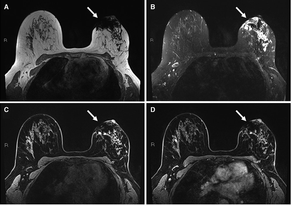 📣 JBI LATEST IMAGE SPOTLIGHT 📣 Superparamagnetic Iron Oxide Tracer on Breast MRI from @UVA Note: Marked susceptibility artifact in left inner breast Cause: Intraop sentinel LN loc with superparamagnetic iron oxide (SPIO) Alternative: CEM Read more ➡️ bit.ly/3TpQ97c
