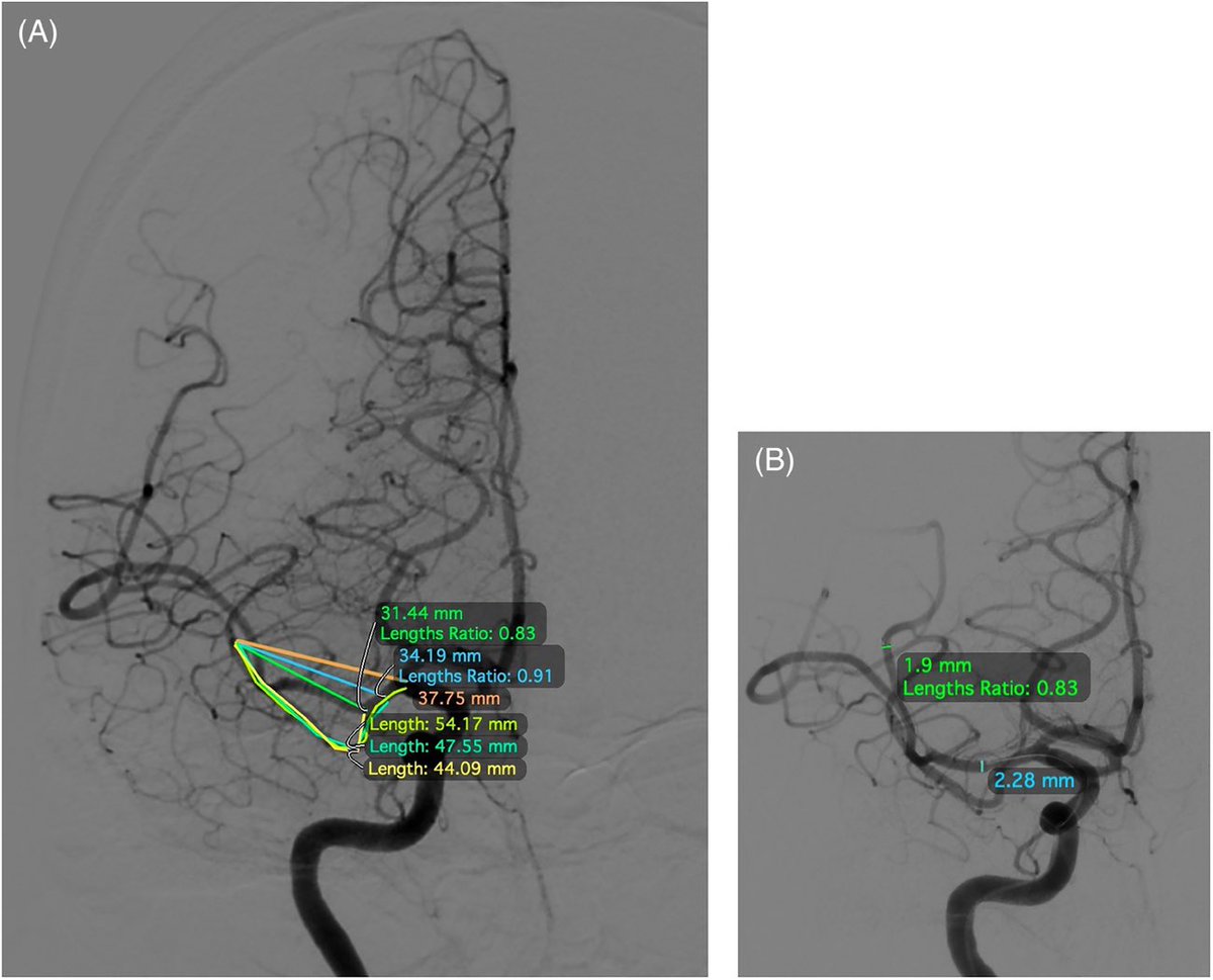 AshuJadhav (@ashupjadhav) on Twitter photo Arterial Tortuosity Is a Potent Determinant of Safety in Endovascular Therapy for Acute Ischemic Stroke | Stroke: Vascular and Interventional Neurology ahajournals.org/doi/full/10.11… <a href="/SVINJournal/">Stroke: Vascular and Interventional Neurology</a> <a href="/svinsociety/">SVIN</a> <a href="/StrokeAHA_ASA/">Stroke AHA/ASA</a> Arterial Tortuosity Is a Potent Determinant of Safety in Endovascular Therapy for Acute Ischemic Stroke | Stroke: Vascular and Interventional Neurology ahajournals.org/doi/full/10.11… <a href="/SVINJournal/">Stroke: Vascular and Interventional Neurology</a> <a href="/svinsociety/">SVIN</a> <a href="/StrokeAHA_ASA/">Stroke AHA/ASA</a>