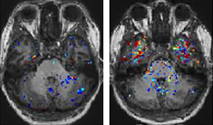 In long COVID patients with brain fog (brain scan at right), dye injected into the bloodstream tends to leak into the brain (see colored speckles) more so than in people without brain fog (left). sciencenews.org/article/long-c…