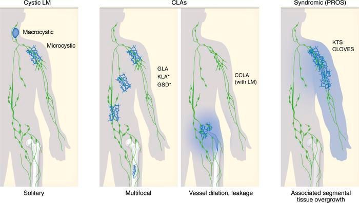 jclinicalinvest's tweet photo. #Review: Lymphatic malformations: mechanistic insights and evolving therapeutic frontiers: https://t.co/MdSKUCxid0 

@Milena_kp @makinenlab @uppsalauni https://t.co/GSOo6633ye