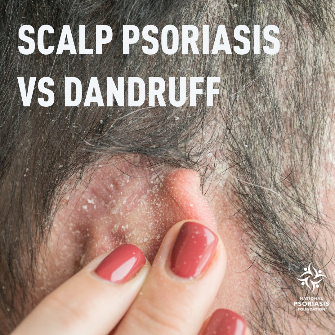 No, it's not dandruff....... or is it? They may look similar, but they can often require different treatments. Head to our website for expert insights on distinguishing and treating scalp psoriasis versus dandruff. psoriasis.org/advance/scalp-…