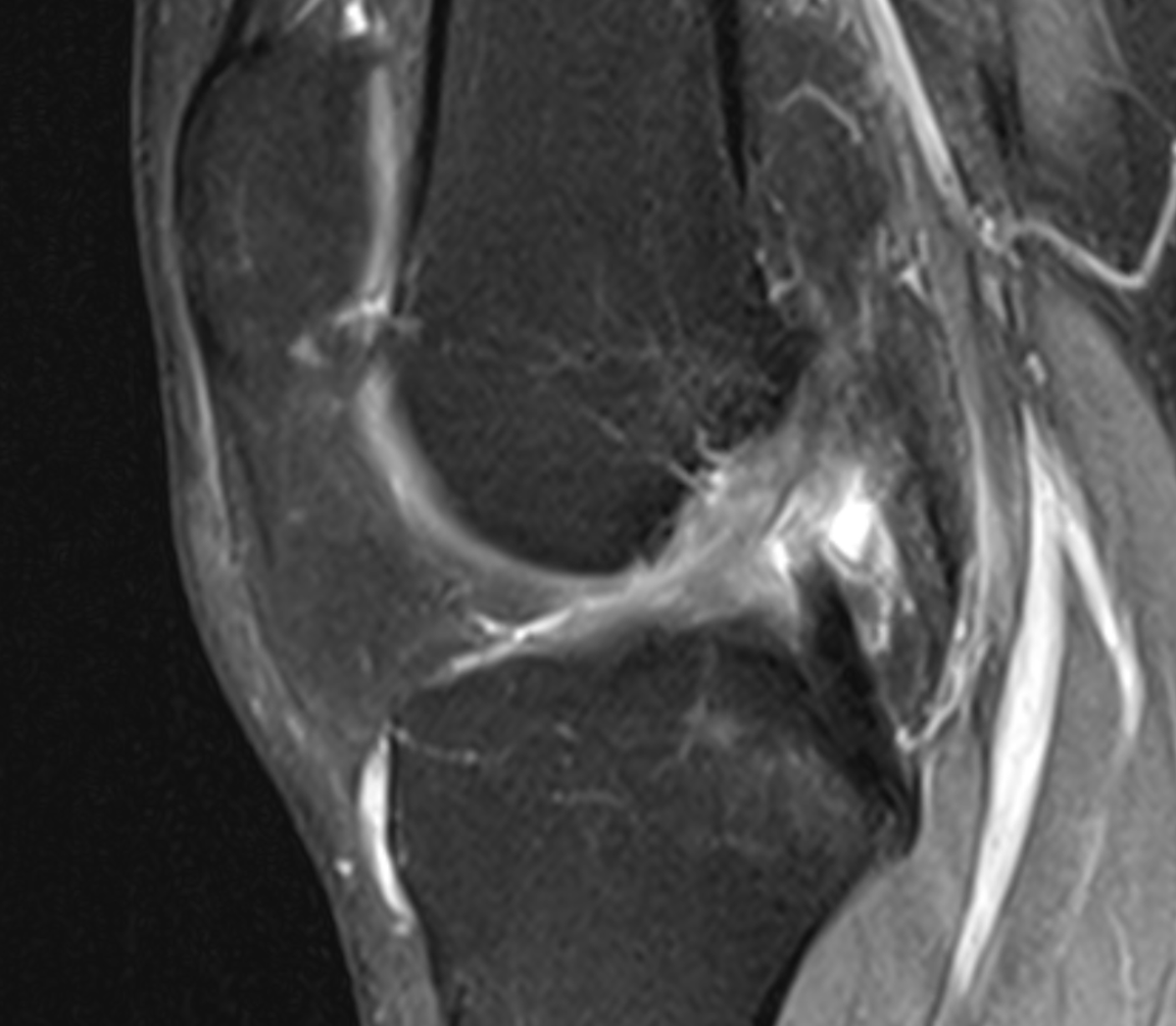 Segond fx. ALL avulsion fx. When present, anterolateral ligament is clearly depicted as the hipointense lineal structure attaching to the bone fragment. Of course, ACL is torn. #msk #knee