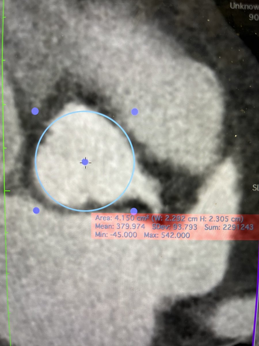 😱 #TAVR case. Petit & obese 🍟👵🏻 w/v small annulus & v low LM (~7 mm, SOV 21) Do u believe BEV 20 mm (less diam) or Neo2 S (upper crown) have a lower risk of LM occlusion? I vote for AVR 🔪unless 🚫 risk …. If #TAVR then stent in the LM for sure (no exp w/BASILICA & 💵)