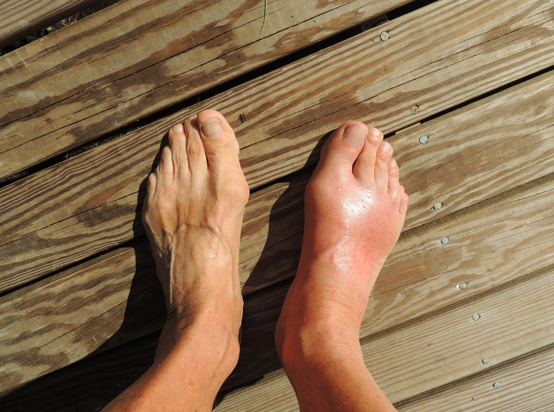 coupoly's tweet photo. Decoding Gout: Unveiling the Diagnostic Journey
#GoutDiagnosis #HealthcareEvaluation #MedicalHistory #Arthrocentesis #UrateCrystals #BloodTests #Hyperuricemia #ImagingStudies #JointDamage #ClinicalExamination #MedicalInsights #HealthcareKnowledge #GoutAwareness #Rheumatology #HealthScreening #DiagnosisTechniques #HealthcareApproaches #MedicalTests #JointHealth
Learn about the intricate process of diagnosing gout and how healthcare providers use a combination of clinical evaluation, medical history, and advanced tests to confirm the presence of this condition. Discover the significance of physical examinations, joint aspirations, blood tests, and imaging studies in identifying gout attacks and differentiating them from other joint-related issues. Gain insights into the nuances of gout diagnosis to ensure accurate and effective treatment strategies.
https://t.co/8IXI8Rclbd