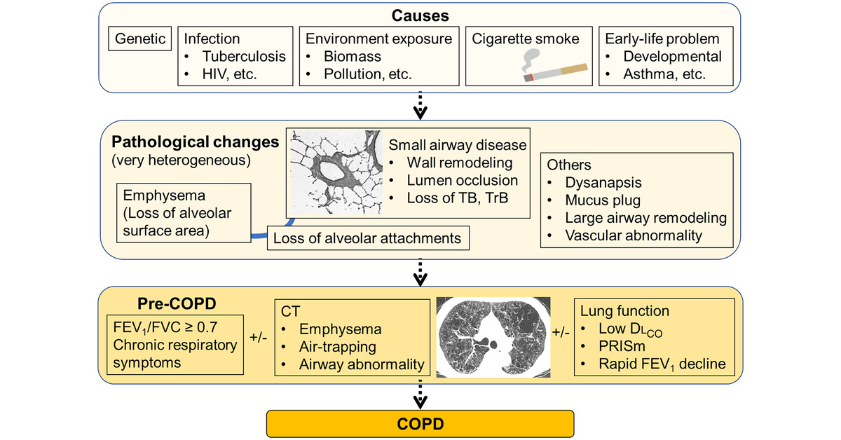 ATSBlueEditor's tweet photo. Increase Attention to Computed Tomography Findings of Emphysema without Airflow Limitation: Small Airway Disease Is Already There

🔓 Open Access
🔗 https://t.co/TNoZ5Hu3mQ https://t.co/UXuBdznx46